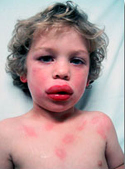 Allergy In Lips